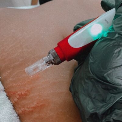 Dermapen en estrías Dermapen en estrías