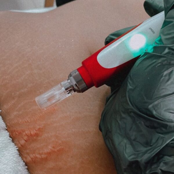 Dermapen en estrías Dermapen en estrías